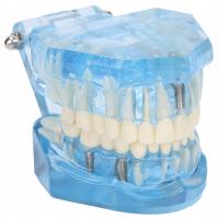 Blue acrylic model of dental teeth