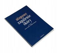 Atopowe zapalenie skóry Praca zbiorowa