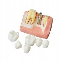 имплантат демонстрация мост зубы Teach
