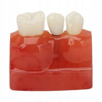 4 -krotny model implantu implantów dentystyczny minasom R4