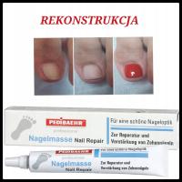 Реконструкция ногтей онихомикоз протез ногтя